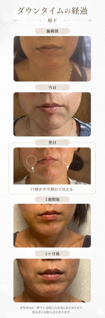 ショッピングリフト20本のダウンタイム経過